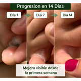 Progresión del tratamiento en 14 días